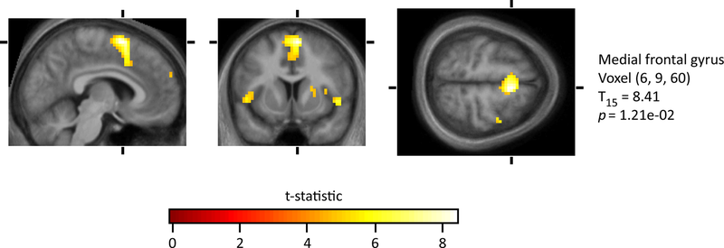 Illustration for article titled Here's What Your Brain Is Doing When You Really, Really Hate Someone
